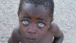 Un niño africano sorprende por sus ‘ojos de zafiro’