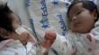 Milagro de amor: bebé siamesa salvó de la muerte a hermana