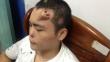 China: Médicos desarrollan una nueva nariz en la frente de paciente