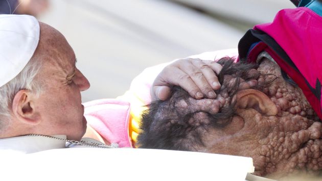 Papa Francisco acogió en su regazo a paciente con neurofibromatosis. (EFE)