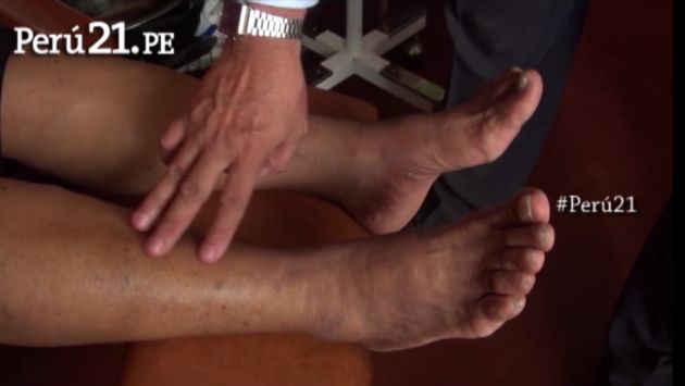 Consejos para el cuidado del pie diabético en verano. (Perú21)