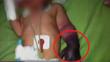Bebé sufrió amputación de mano tras negligencia médica en hospital de Vitarte
