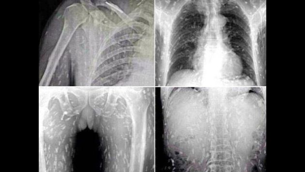 Radiografía del paciente infestado de larvas en China. (Dailymail.co.uk)