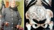 Chile: Descubren que anciana de 92 años tenía feto momificado en su vientre
