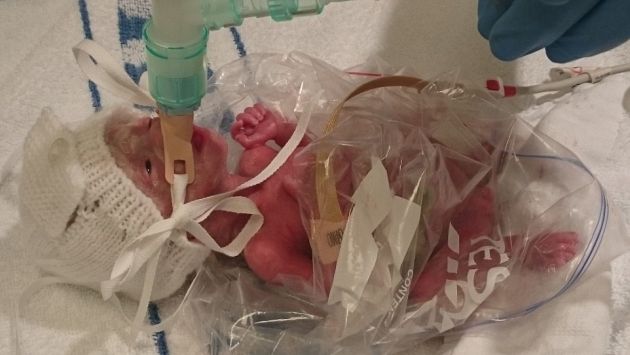 Inglaterra: Médicos usaron una bolsa de sándwich para salvarle la vida a una bebé prematura. (swns.com)
