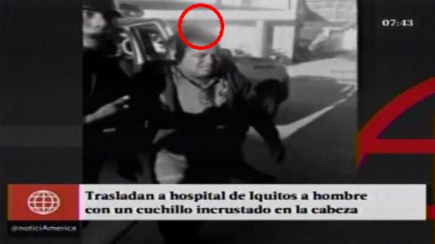 El herido fue evacuado al Hospital Regional de Loreto. Fue derivado a la Unidad de Cuidados Intensivos (USI). (América Noticias)