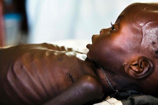 Alerta por desnutrición infantil en ciudades de África. (AFP)