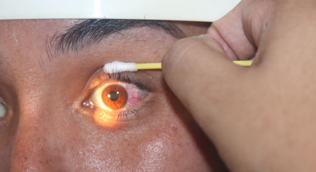 La conjuntivitis se caracteriza por el enrojecimiento de los ojos con ardor o picazón. (Difusión)